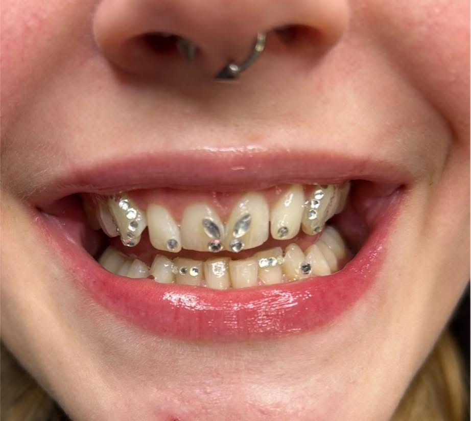 Full smile showing multiple tooth gems