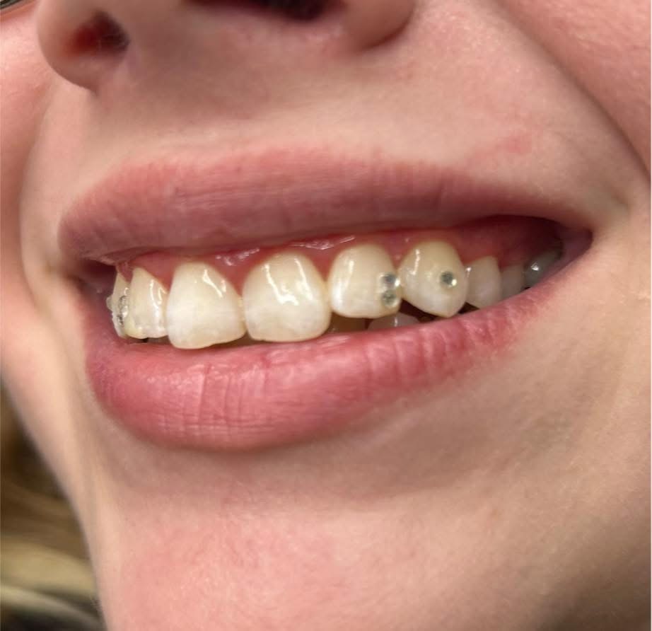 Close-up of a tooth gem placement on a smile